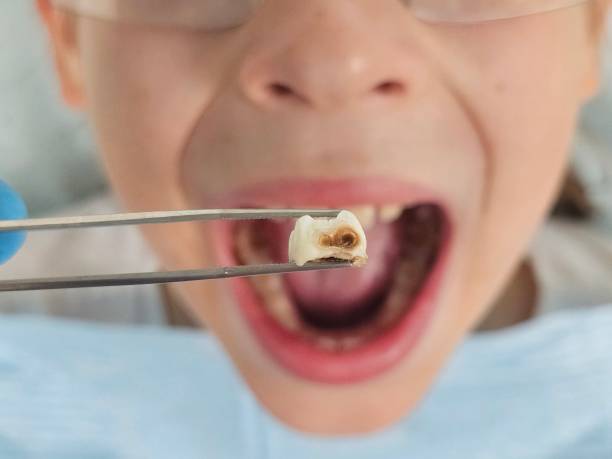 Best Broken or Cracked Tooth Emergency Dentist in Deerfield Beach, FL